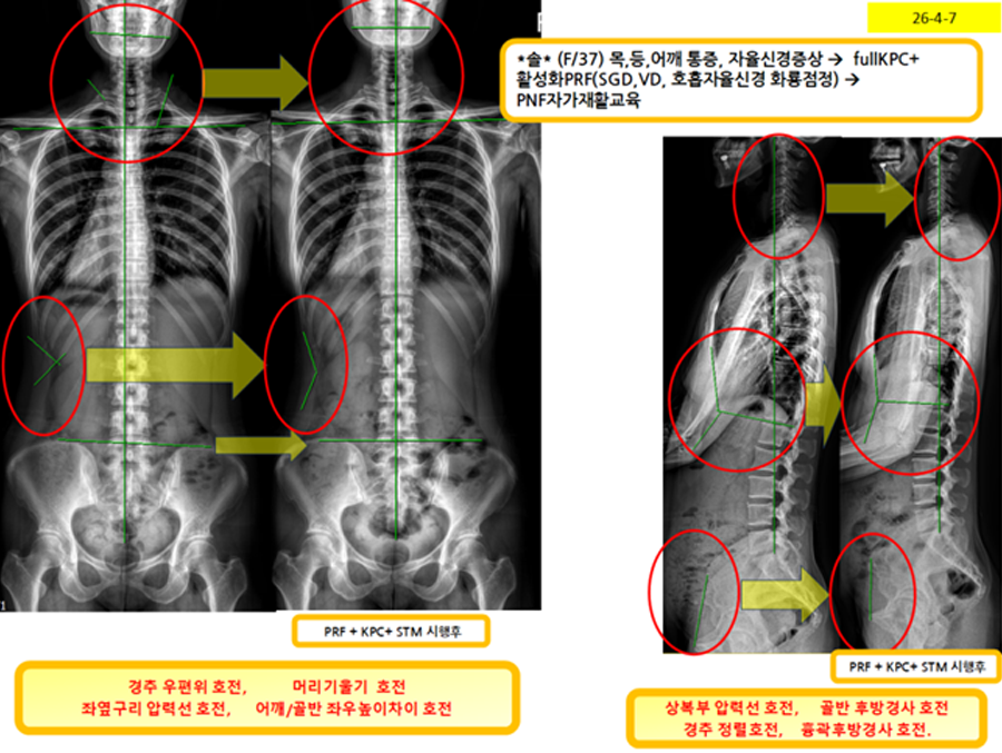 만성-통증-및-자율신경-이상에-대한-초음파-유도하-호흡-근육-및-자율신경-타겟팅-증례