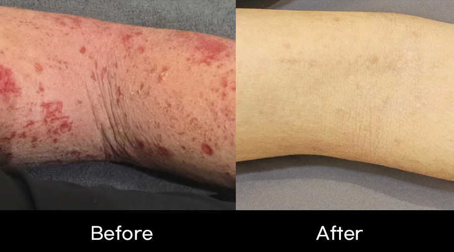 임상사례_일상생활-불가-수준의-중증-전신-소양증(가려움증)-피부-재생-임상