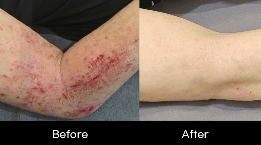 임상사례_일상생활-불가-수준의-중증-전신-소양증(가려움증)-피부-재생-임상02