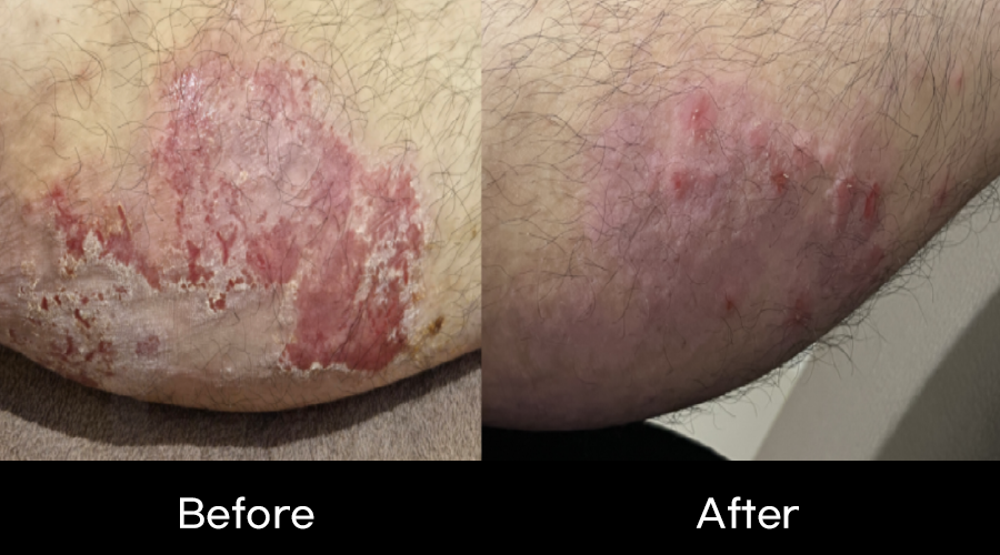 임상사례_일상생활-불가-수준의-중증-전신-소양증(가려움증)-피부-재생-임상03