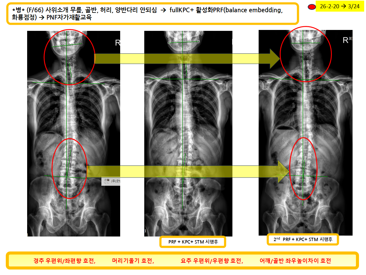 무릎·골반·허리 통증 환자의 반복 치료 후 전신 정렬 변화