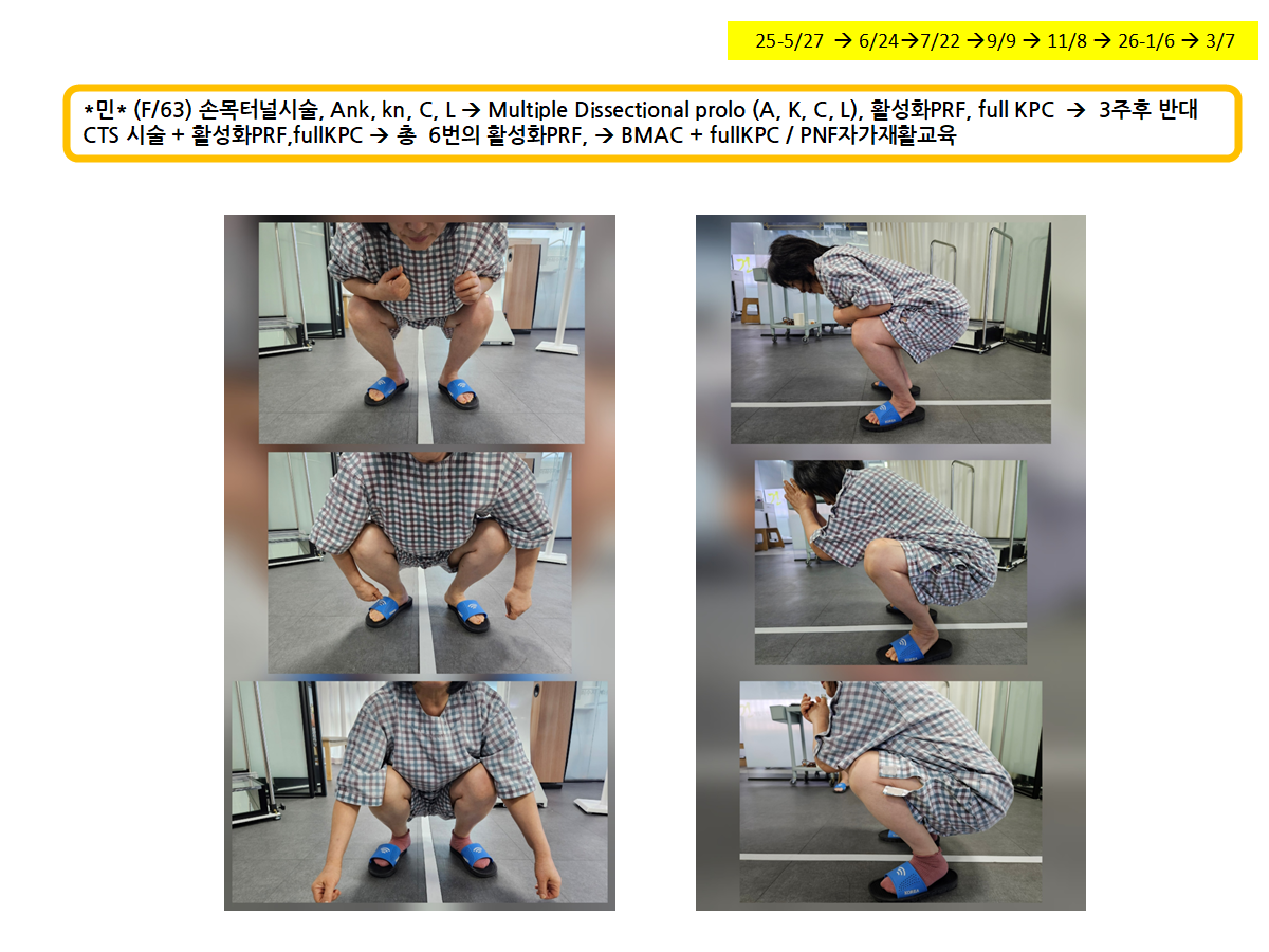 수근관증후군 및 복합 근골격계 치료 과정에서 확인한 스쿼트 기능 변화