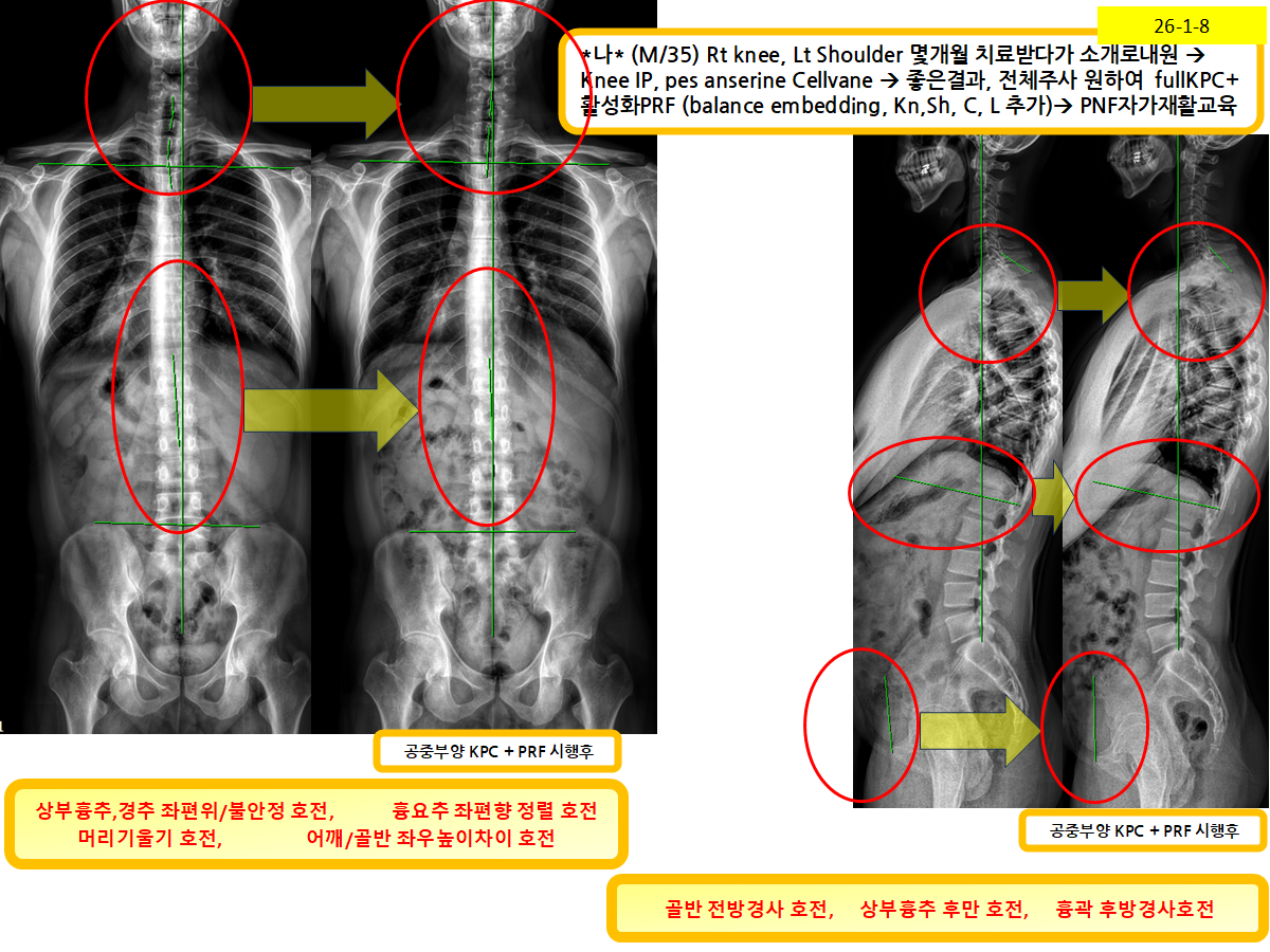 우측 무릎·좌측 어깨 통증 환자의 전신 KPC·활성화 PRF 치료 후 정렬 변화